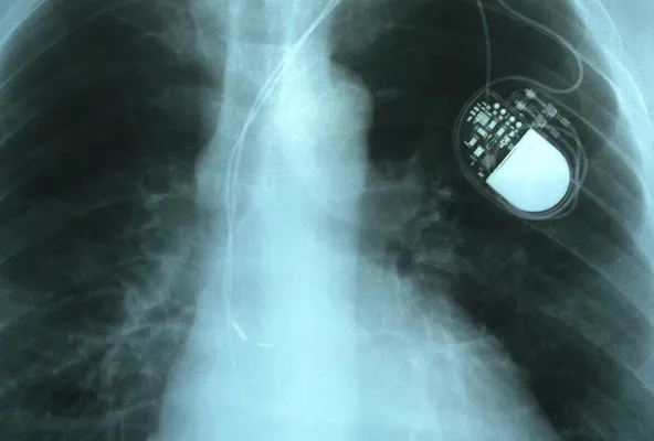 体内に心臓ペースメーカーが埋まっている様子